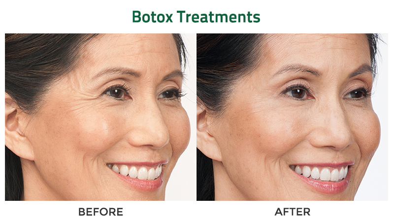 Before and after photos of an Asian woman smiling who received Botox treatments