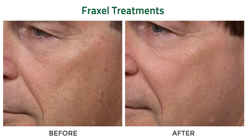 Before and after photos of a Caucasian male who received Fraxel treatments