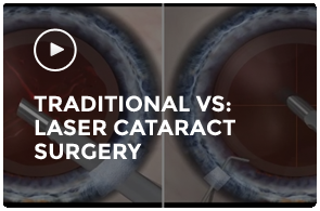 Traditional vs. Laser Cataract Surgery