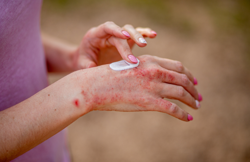 women moisturizing hands to manage eczema