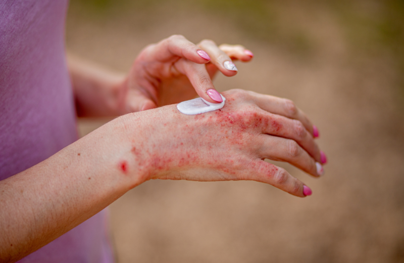 Managing eczema: what you need to know