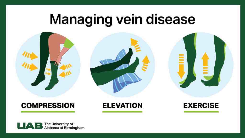 Managing vein disease infographic