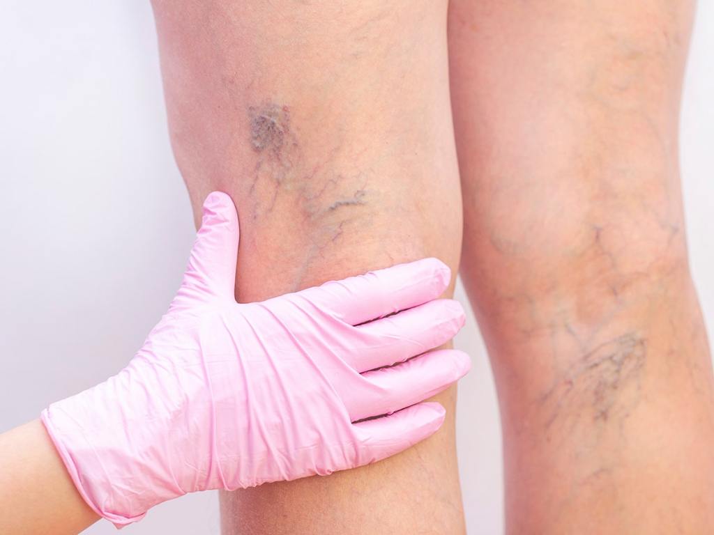  Vein pain explained: Types, symptoms, and treatment options