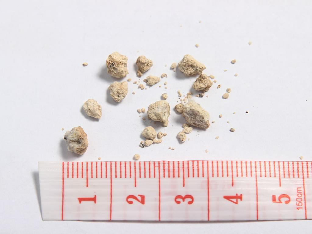 kidney stones next to a ruler