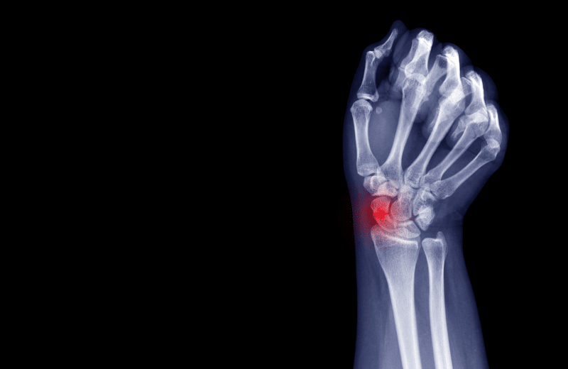 xray of a Scaphoid fracture